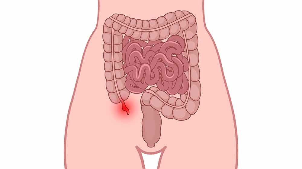 Diagram of the human digestive system with highlighted appendix
