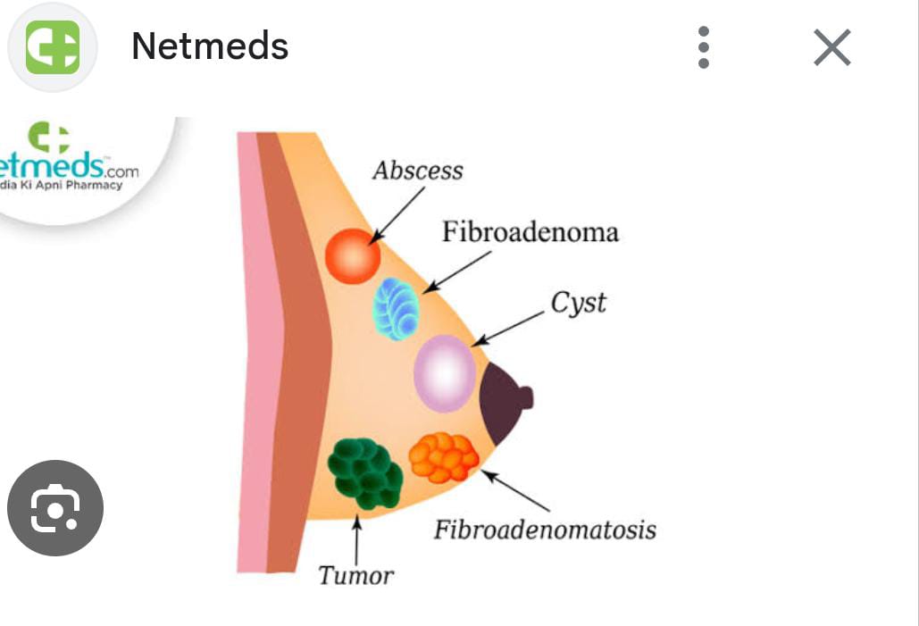 Diagram of breast anatomy with highlighted lump