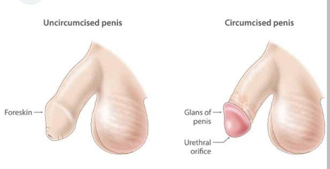 Diagram of male anatomy with and without circumcision