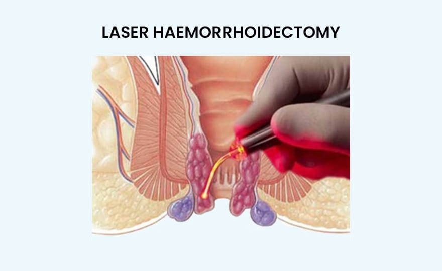 Laser surgery procedure